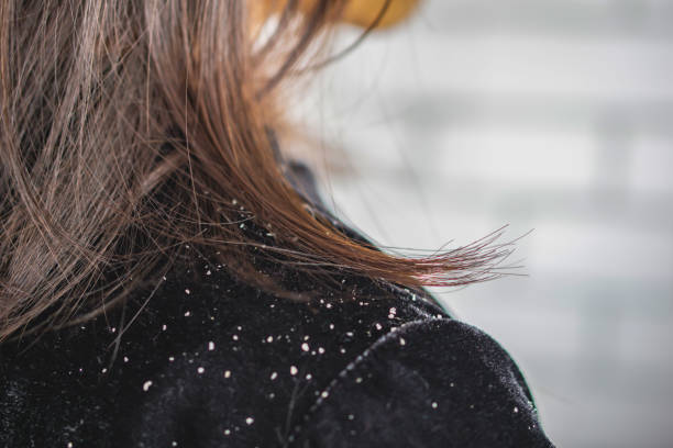 Dry or Flaky Hair